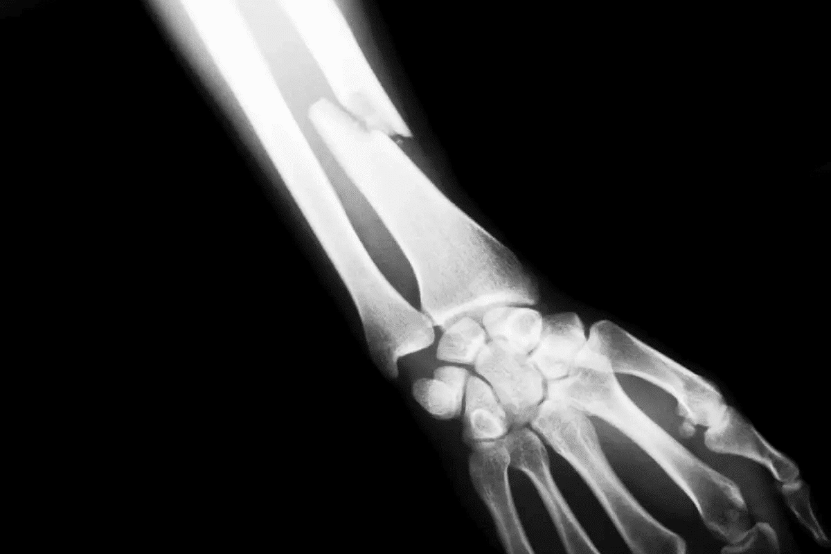 Открытый перелом кости руки. Многооскольчатый перелом голени рентген. Рентгенограмма перелом кости. Перелом Галеацци рентген. Травматический перелом рентгенограмма.