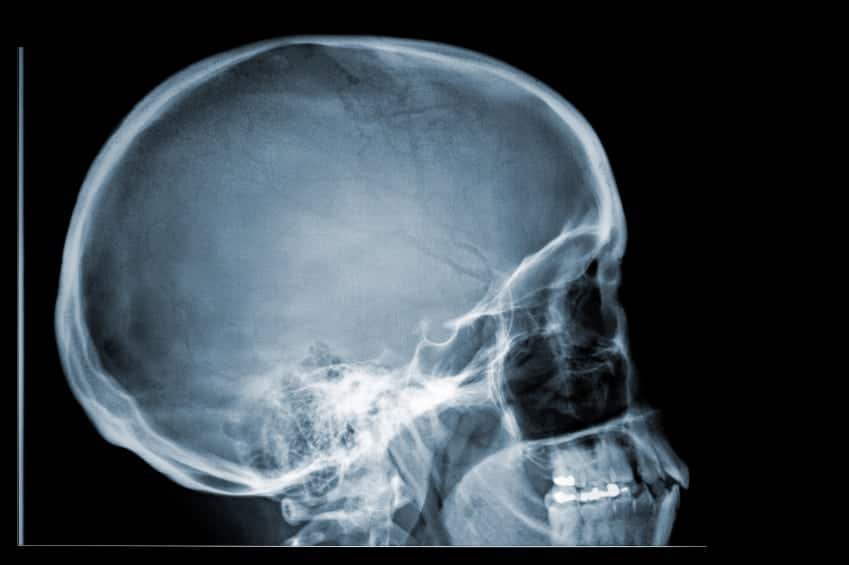 signs of skull fracture